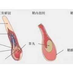 医学科普｜不容忽视的男性急症——睾丸扭转