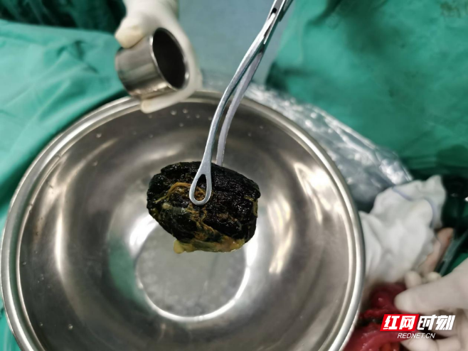 警惕“甜蜜负担”!过量食用柿子当心肠梗阻