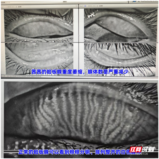 揪出“元凶”!7岁女童反复麦粒肿,竟是10只螨虫在作祟