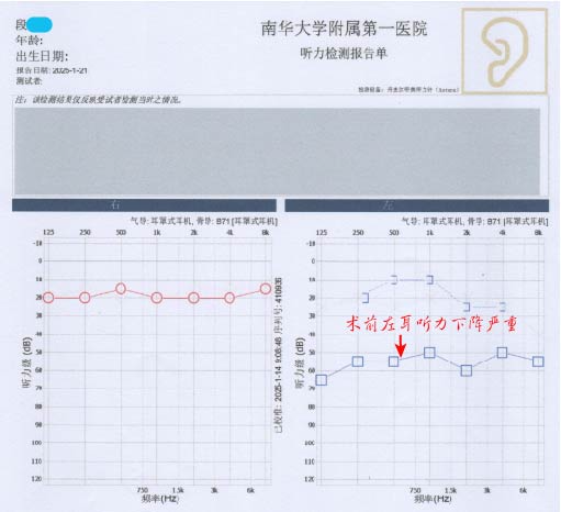 南华附一医院率先在区域内完成高难度的特殊类型人工镫骨植入术