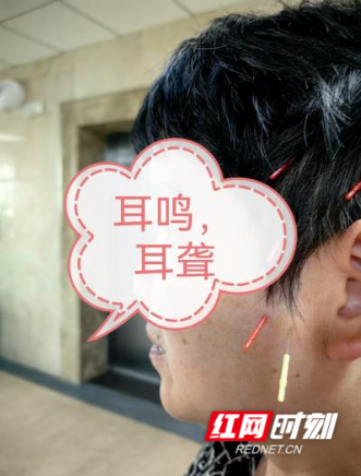 南华医院麻醉科应用颊针疗法成功治愈顽固性耳鸣患者