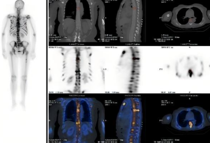 核医学“侦察”破迷雾 南华医院揪出隐匿的急性白血病