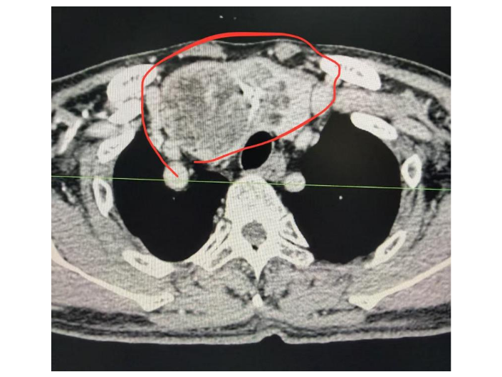 衡阳市中心医院乳甲外科成功为六旬患者切除胸骨后巨大甲状腺肿