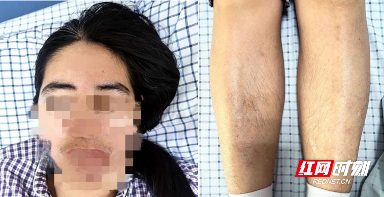 女性出现“男性化”,警惕肾上腺作怪!南华附一单孔腹腔镜微创切除近7公分嗜铬细胞瘤