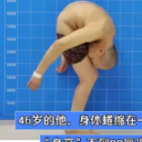 身体被敲断4次，“折叠”20多年的他终于站起来了！
