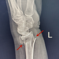 摔倒易致手腕骨折 如何正确应对要牢记三点