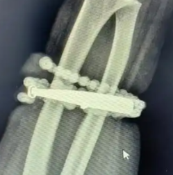 女子手镯10年没摘竟“长”进肉里！医生：再晚点就保不住了