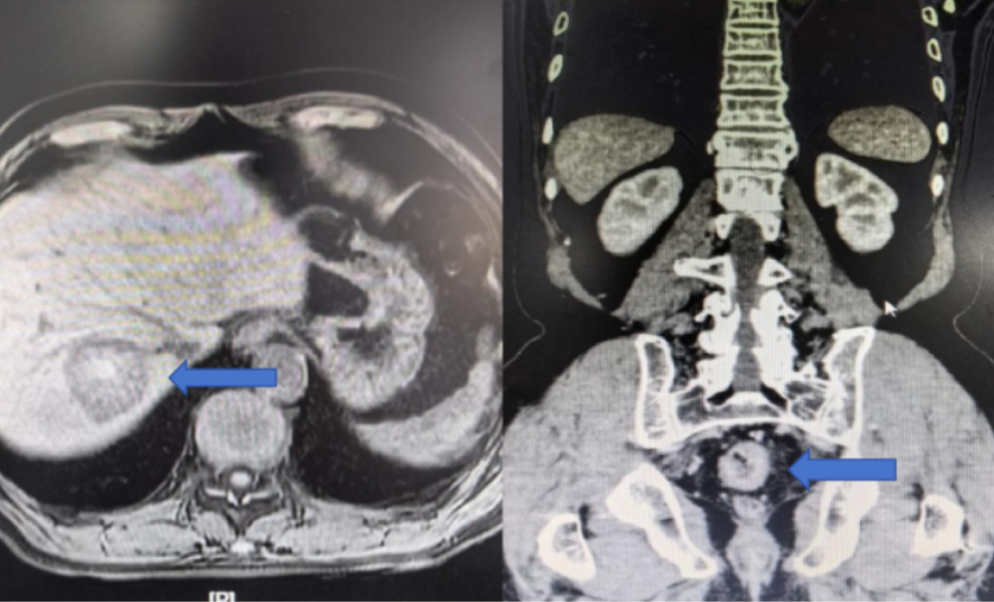 多学科协作攻坚 直肠癌合并肝转移患者同期切除获新生