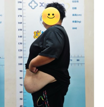 25岁小伙体重329斤  袖状胃切除术助其破除减肥困境