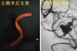 湘雅三医院成功应用密网支架介入术治疗高难度“镜像”脑动脉瘤
