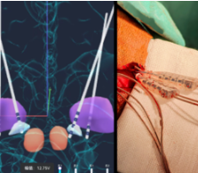 “一拖四”脑深部电刺激术助力17岁肌张力障碍少年挣脱“无形枷锁”