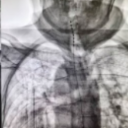 给疼痛装上“开关”！湘雅三医院疼痛科开展多例高龄患者脊髓电刺激术