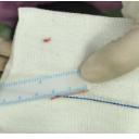 惊险!一根鱼刺穿透食管壁扎向颈动脉,医生紧急手术取出