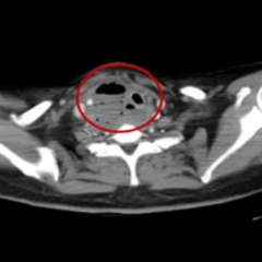 春节里的两场“排雷战”：湘雅三医院成功救治两例高危颈部深部脓肿患者