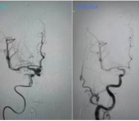 身负三颗“炸弹”又遇颅内出血，湘雅三医院神经外科精准栓塞化解危机