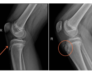 踢球后膝盖前方疼痛，或是青春期的运动“勋章”