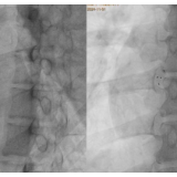 岳阳市中医医院心血管病科：可降解封堵器 补心不留痕