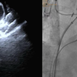 岳阳市中医医院心血管病科:一站式手术守护心脑健康