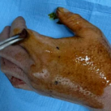 与蛇毒赛跑！岳阳市中医医院成功救治蝮蛇咬伤患者