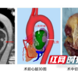 心脏连同肿瘤切除后再植入 湘雅二医院完成湖南首例自体心脏移植术