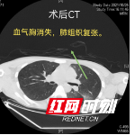 几个舞蹈跳跃动作后，大一男生胸腔出血两千毫升