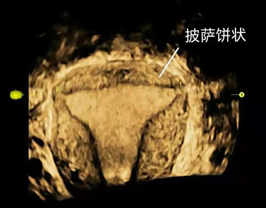 子宫B超扇形图详解图片