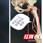 长沙市第三医院成功开展人工血管搭桥术