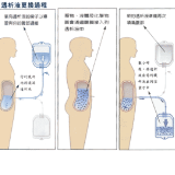 长沙市第三医院：在家就可以做的透析，你了解吗？