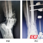 严重车祸致外卖小哥命悬一线 专家团队为其“保命又保腿”
