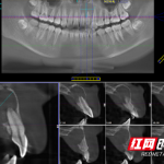 牙外伤未重视，6年后女孩牙髓神经完全坏死