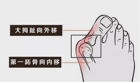 名医话健康李三忠：拇趾外翻畸形“丑”，磨人的“大脚骨”真痛苦227.png