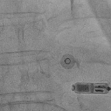 南华医院心血管内科成功为93岁高龄患者植入无导线心脏起搏器