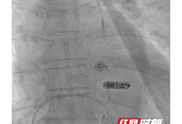 南华医院心血管内科成功为93岁高龄患者植入无导线心脏起搏器