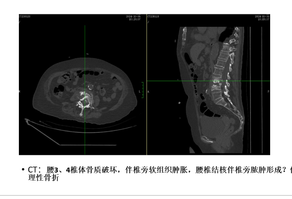 衡阳市中心医院脊柱外科团队为87岁脊柱结核老人“撑腰”