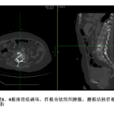 衡阳市中心医院脊柱外科团队为87岁脊柱结核老人“撑腰”