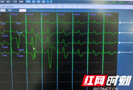 南华医院神经外科成功实施衡阳首例神经导航与电生理技术辅助脑功能区病灶切除手术