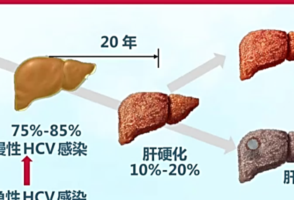 全国爱肝日 南华大学附属第一医院开设“丙肝专病门诊”