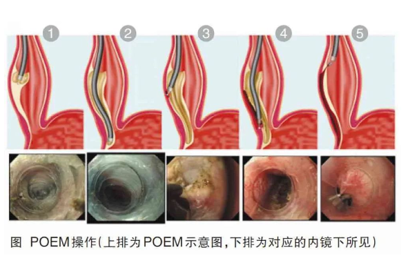 “小隧道”解决“大难题” 南华附一POEM术守护进食生命通道