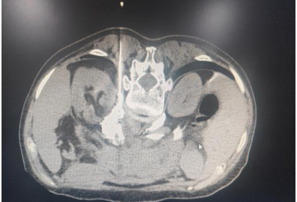 南华医院介入血管外科成功实施胰腺癌腹腔神经丛毁损术，为老年癌症患者减轻疼痛