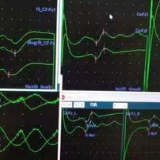 南华医院：新一代电生理监测为医生装上“精准之眼”