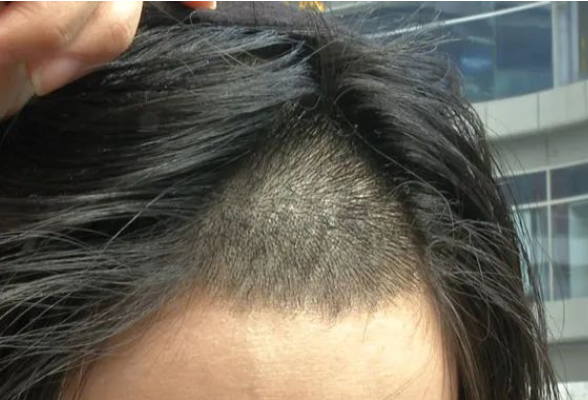 实惨！长沙一女子去理发店做头发，店员把她发际线烧了