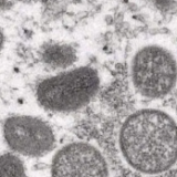 英卫生官员证实：英国已出现猴痘病毒社区传播