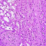 美疾控中心：一些不明病因儿童肝炎可能为腺病毒所致