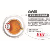 糖尿病居然还会诱发白内障