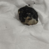 医疗服务提升年丨学科联合化解危机！13岁少年鼻腔异物致咯血，医生紧急手术解除风险