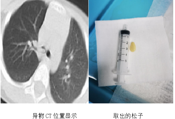 松子成“元凶” 永州市中心医院一镜解危急