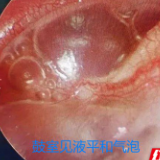 永医科普丨耳鼻喉科常见疾病——分泌性中耳炎