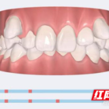 永医科普丨隐形正畸技术，让您在微笑中悄悄变美