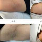 医疗服务提升年丨永州市中心医院皮肤科引进FUE微创技术 助腋臭患者轻松告别困扰