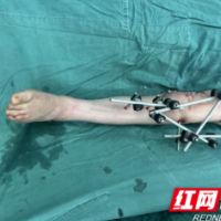 医疗服务提升年丨永州市中心医院：仁心矫形重启行走希望